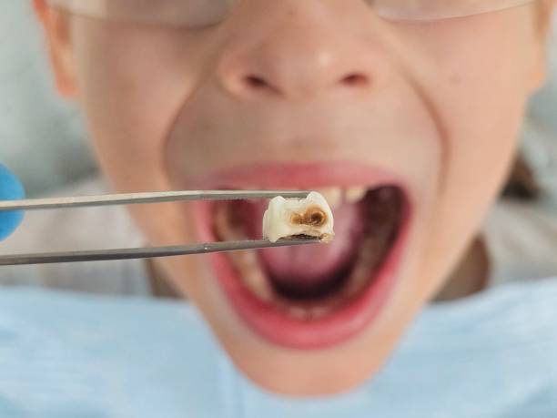 Best Emergency Dental Care for Abscessed Tooth in Monongah, WV